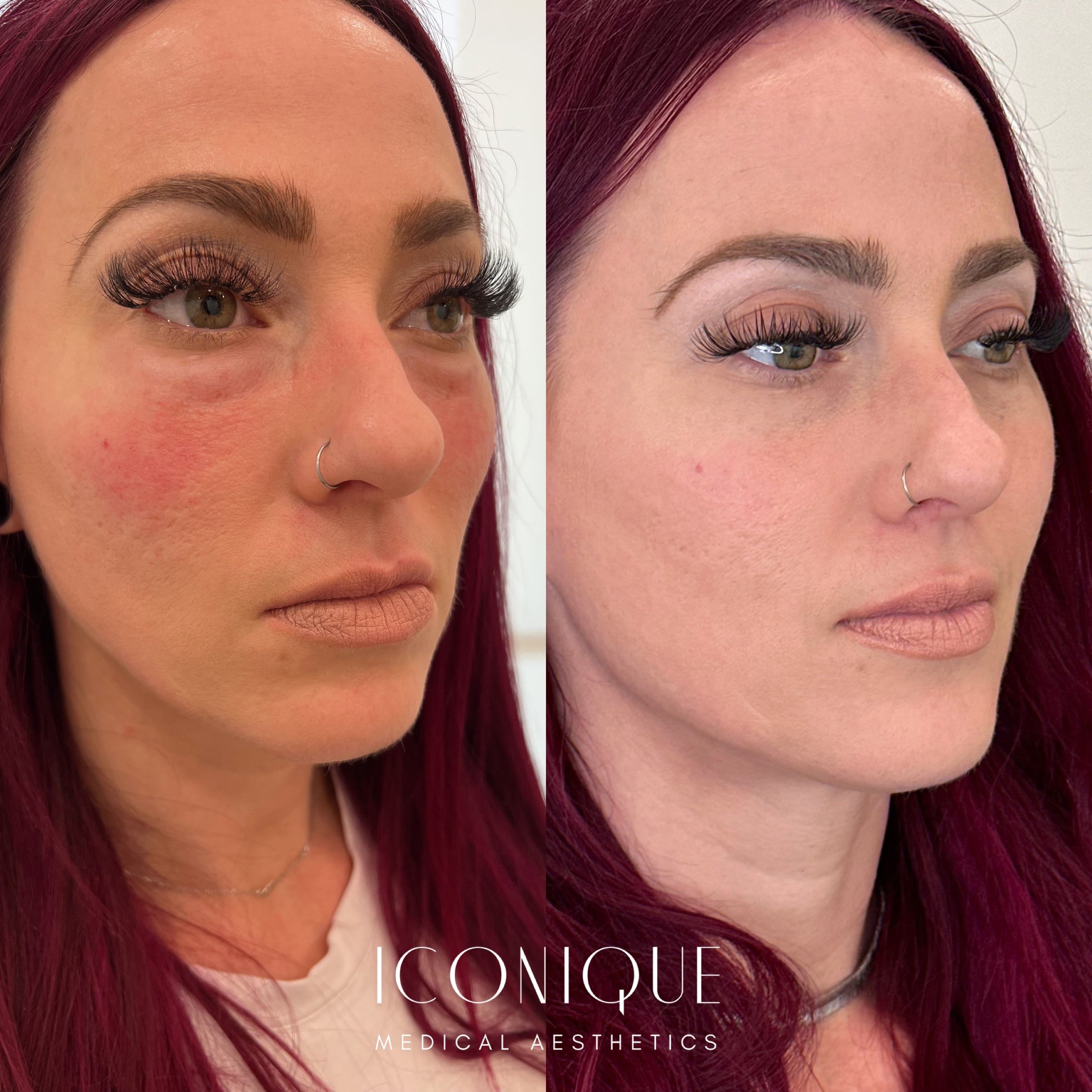 PRF EZ GEL 1 session Iconique Medical Aesthetics OC Med Spa